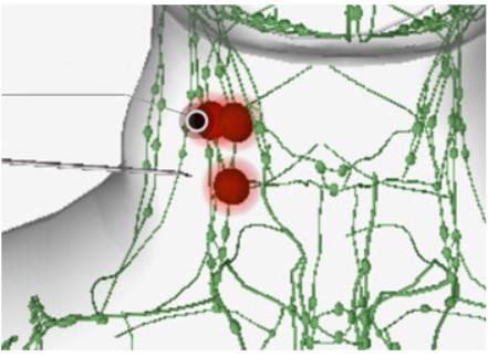 lymph_node_aspiration 