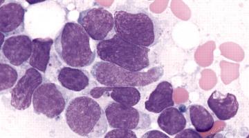 leukemia 