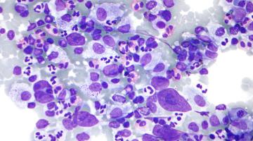 hodgkins lymphoma